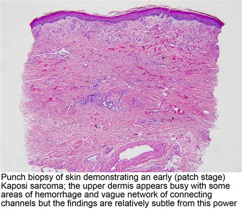 Pathology Outlines - Kaposi sarcoma