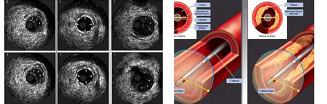 Dr Sharath Reddy | Intravascular Ultrasound (IVUS)