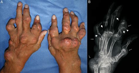 Is gout an easy-to-treat disease? The importance of health determinants ...