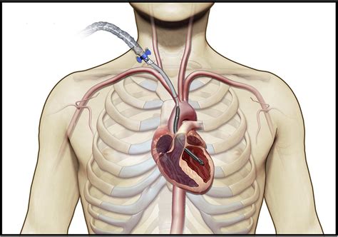 Transinnominate Impella 5.5 insertion as a bridge to transplantation in ...