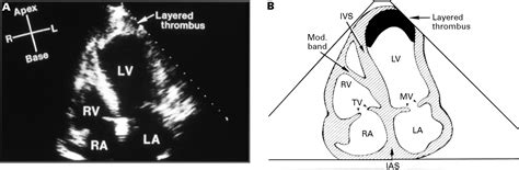 Apical mural thrombus: technical pitfalls | Heart