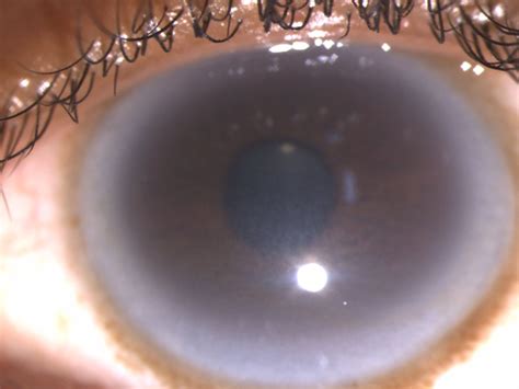 Corneal Arcus