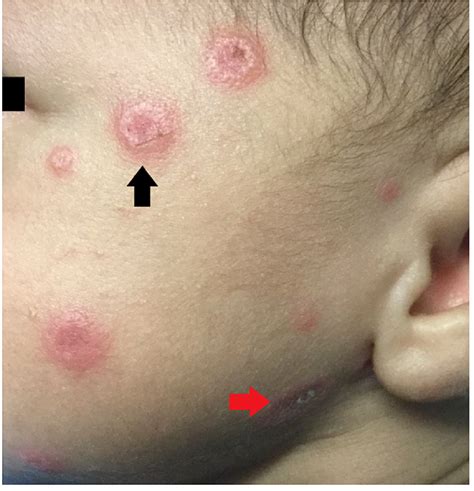 Annular Circular Skin Rash Cancer