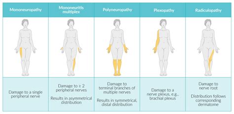 Patrones de afectación neuropática. - Neuropediatoolkit