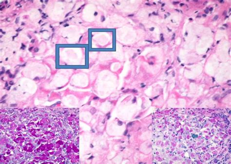 Liver Glycogen Storage Disease Ultrasound