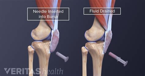 Prepatellar Bursitis Treatment