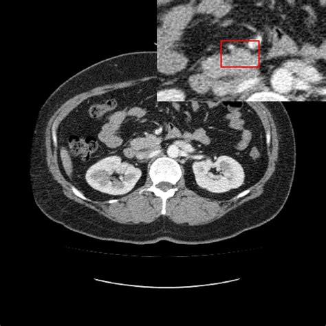 Initial diagnostic abdominal CT scan. No abnormal findings of superior... | Download Scientific ...