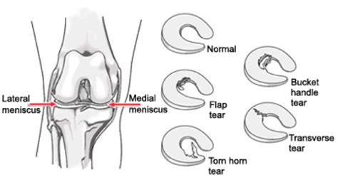 The Different Types of Meniscus Tears (And How They’re Treated ...