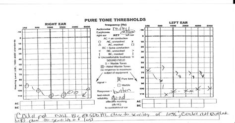 Va Disability Ratings For Hearing Loss Chart