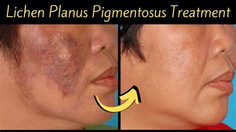 How to cure new type of Pigmentation “Lichen Plans Pigmentosus ...