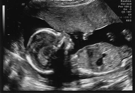 Nyquist: 16 Week Ultrasound - It's a Boy!