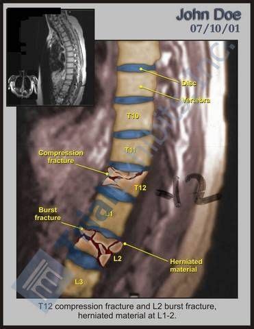 T12 Compression Fracture - L2 Burst | Radiology imaging, Skeletal system anatomy, Medical problems