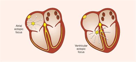 How it Works | Heart Rhythm Clinic