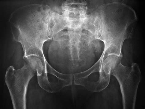 What is a Hip Tear? (with pictures)