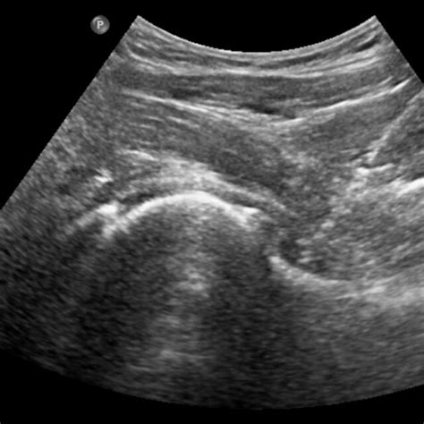 MRI findings of normal, complete tear, degeneration, and partial tear ...