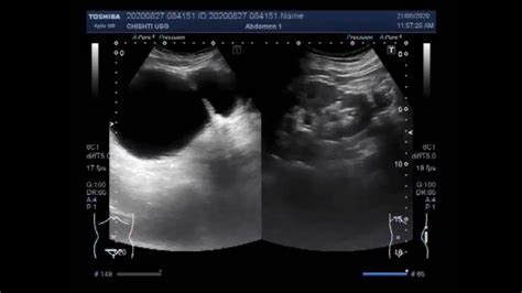 Bladder Diverticulum Ultrasound