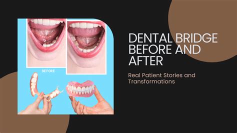 Dental Bridge Before and After