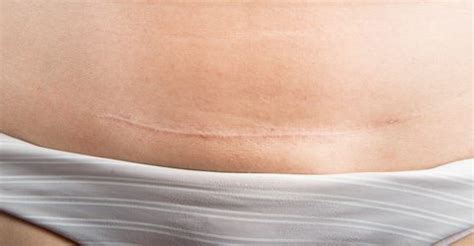 cesarean section scar - hiccups pregnancy