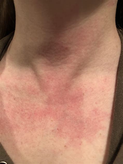 Randomly occurring rashy-looking discoloration on neck and chest ...