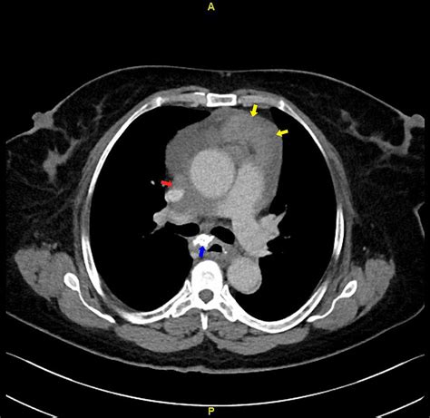 Cureus | Intermittent Superior Vena Cava Syndrome Secondary to Malignant Pericardial Mesothelioma