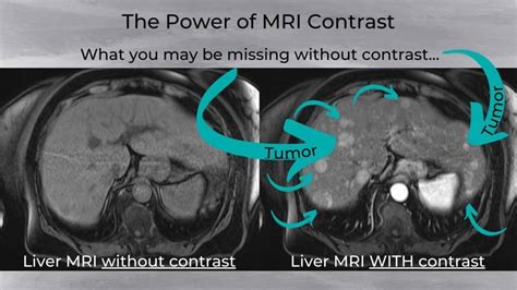 Can I Refuse Contrast Dye for MRI Scans?