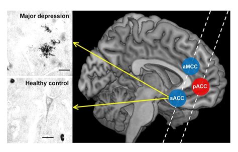 Severe depression is associated with increased microglial quinolinic acid in subregions of the ...