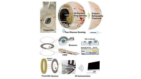 Smart contact lens allows diabetics to monitor their glucose levels through liquid in their eye ...