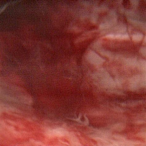 Cystoscopic finding during the first fulguration revealed diffused... | Download Scientific Diagram