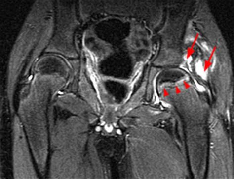 Slipped Capital Femoral Epiphysis | Radsource