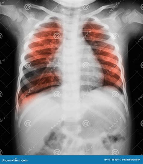 Chest X-ray Image of a Young Boy. Showing Lung Infection Stock Image - Image of patient, heart ...