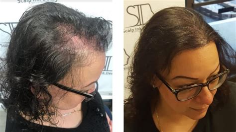 Miami Scalp Micropigmentation for Women | Hair Tattoo Miami