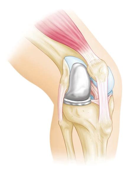 Unicompartmental (Partial) Knee Replacement - OrthoInfo - AAOS