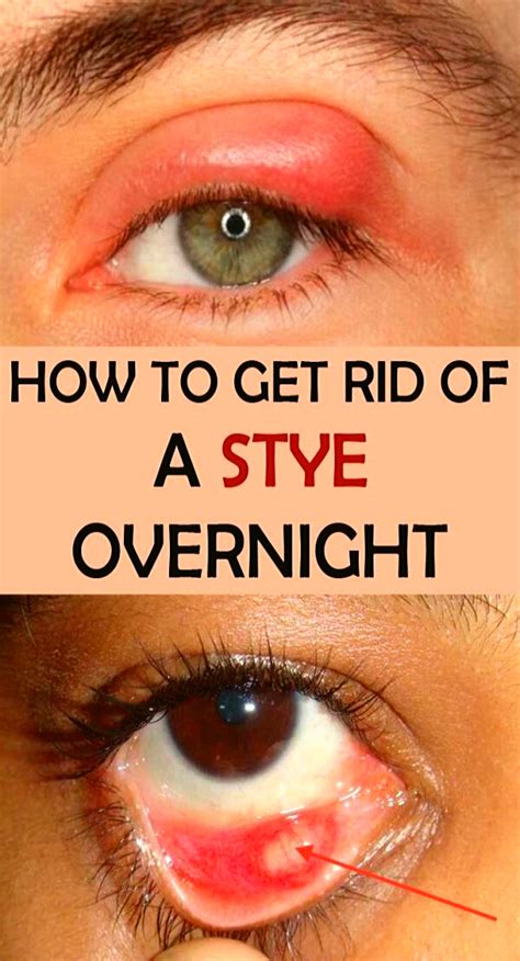 HOW TO GET RID OF A STYE OVERNIGHT | Health, Health remedies, Eye stye remedies