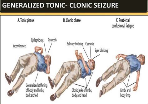 Tonic clonic seizure definition, first aid, causes, symptoms & treatment