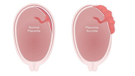 National Accreta Foundation — What is placenta accreta?