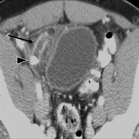 year-old boy with acute appendicitis. CT with oral contrast material ...