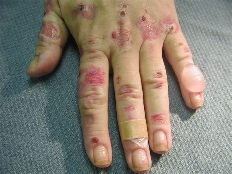 Blisters on hands | MDedge Family Medicine