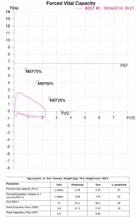 Spirometry flow volume loop of the patients shows flattening of the ...