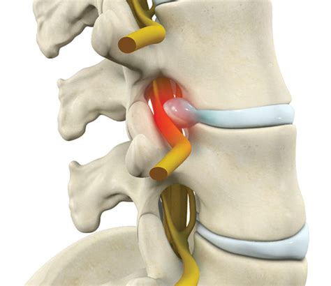 Lumbar Radiculopathy (Nerve Root Compression) • Southwest Florida's Health and Wellness Magazine