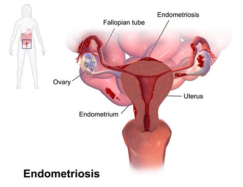 Physiotherapy in the management of Endometriosis · Fiona Mitchell Physio