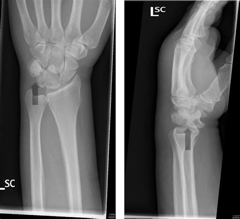 , 2. Preoperative AP and lateral Radiograph, initial x-rays taken in... | Download Scientific ...