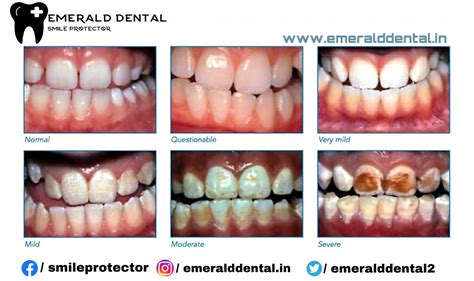 WHAT IS FLUOROSIS - EMERALD DENTAL