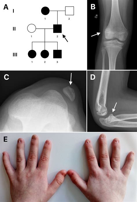 Frontiers | Case Report: Inversion of LMX1B - A Novel Cause of Nail-Patella Syndrome in a ...