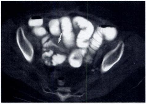 -CT enteroclysis in patients with intestinal obstruction associated... | Download Scientific Diagram