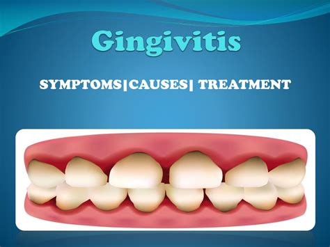 PPT - Gingivitis (Mild Gum Disease) PowerPoint Presentation, free download - ID:7464288