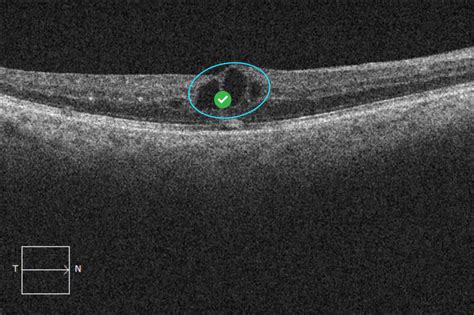 Intraretinal Fluid Empty Cysts - EyeCarePD