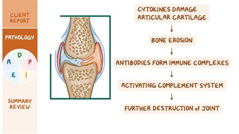 Rheumatoid arthritis (RA): Nursing process (ADPIE) - Osmosis Video Library