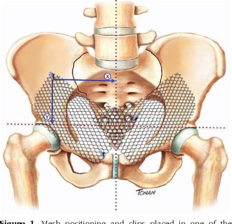 [PDF] Mesh Displacement After Bilateral Inguinal Hernia Repair With No Fixation | Semantic Scholar