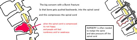 Spine - Burst Fracture — Bone Talks