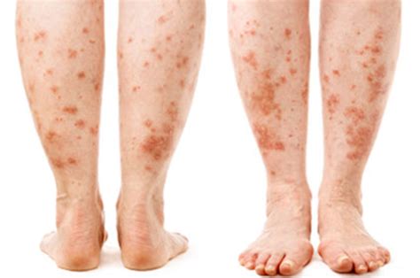 What Causes Leg Rash In Diabetes?